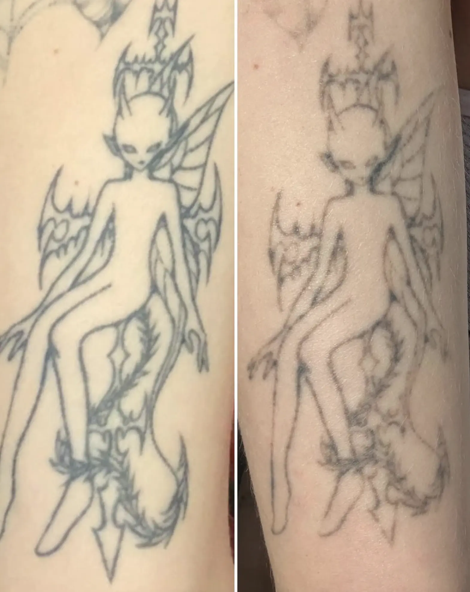 Before and after results of chemical peel tattoo