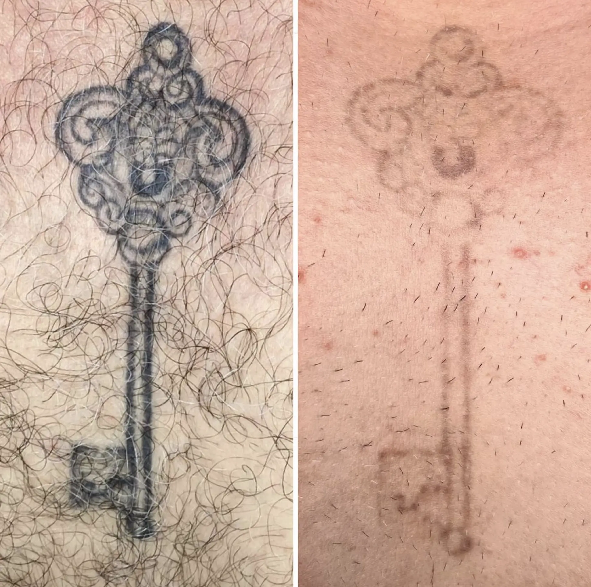 How do I remove a tattoo if I can't afford a laser?