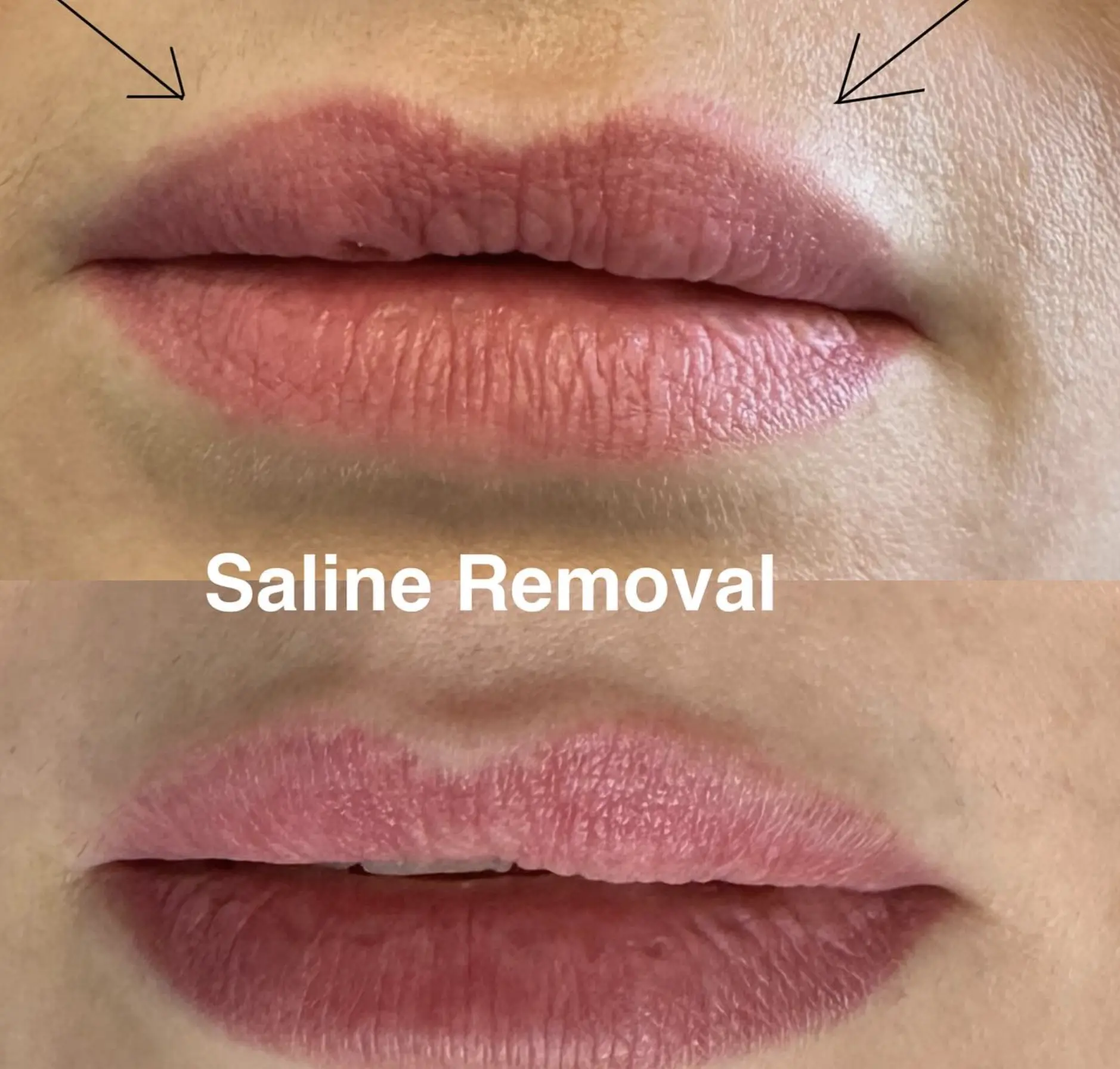 Saline tattoo removal