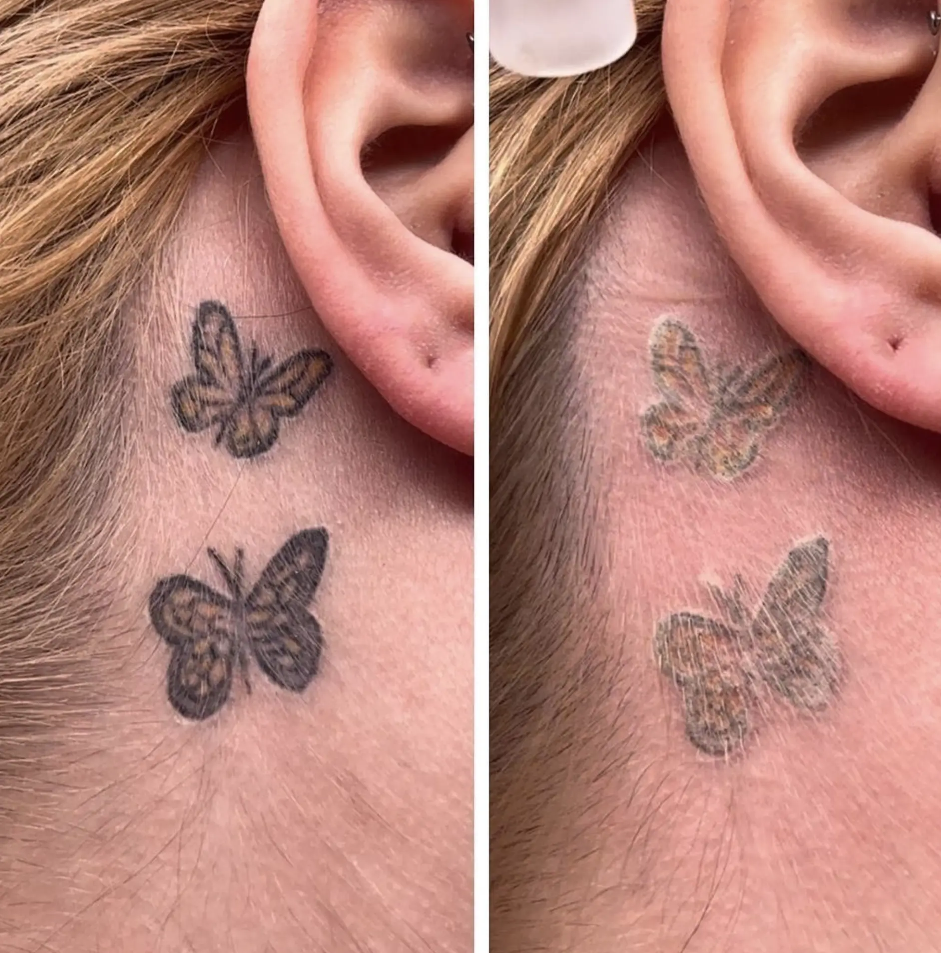 affordable tattoo removal