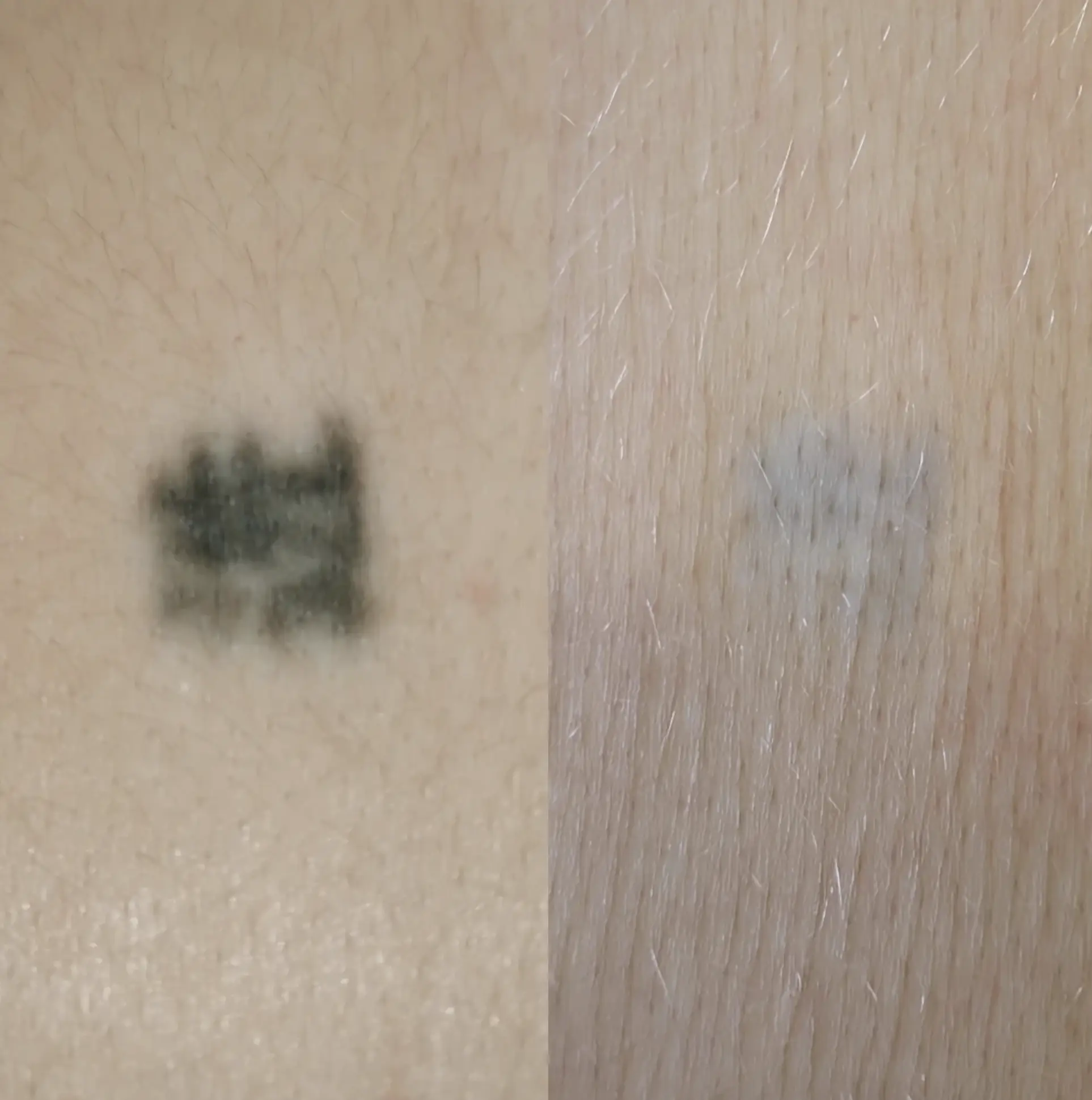 tattoo removal cream