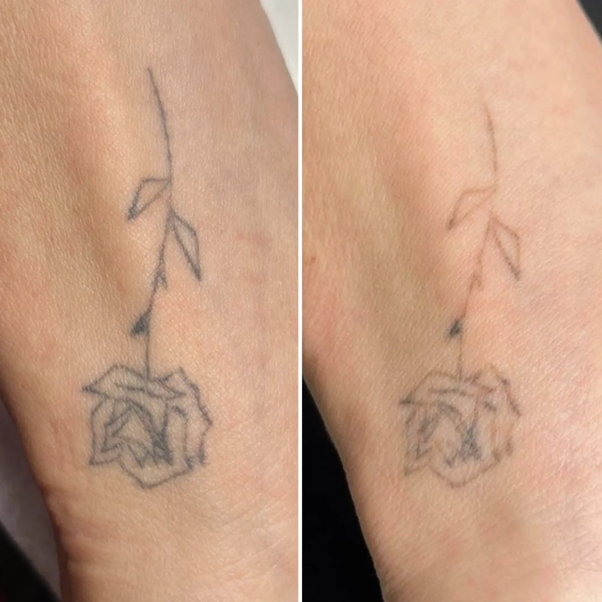 tattoo removal methods